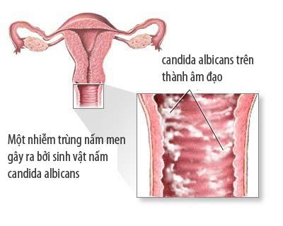 Bệnh viêm âm đạo do nấm – Bạn đã biết chưa?