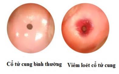 Viêm loét cổ tử cung