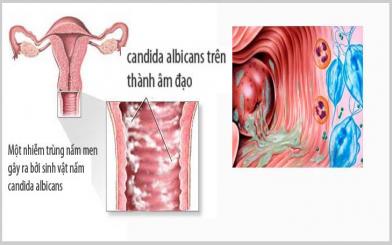 Viêm nhiễm âm đạo – Bệnh phụ khoa không thể coi thường