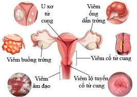Biến chứng của bệnh phụ khoa chữa ngay trước khi quá muộn