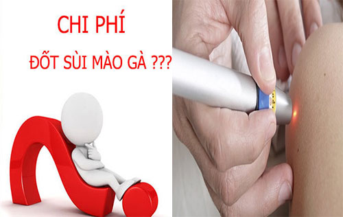 Chi phí đốt sùi mào gà tại Hà Nội hết bao nhiêu tiền 2019