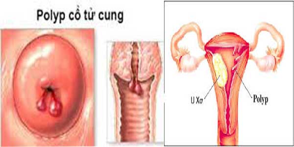 Polyb cổ tử cung